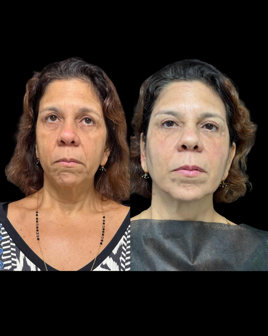 Depoimento de paciente - Harmonização orofacial Niterói Dra. Vania Costa