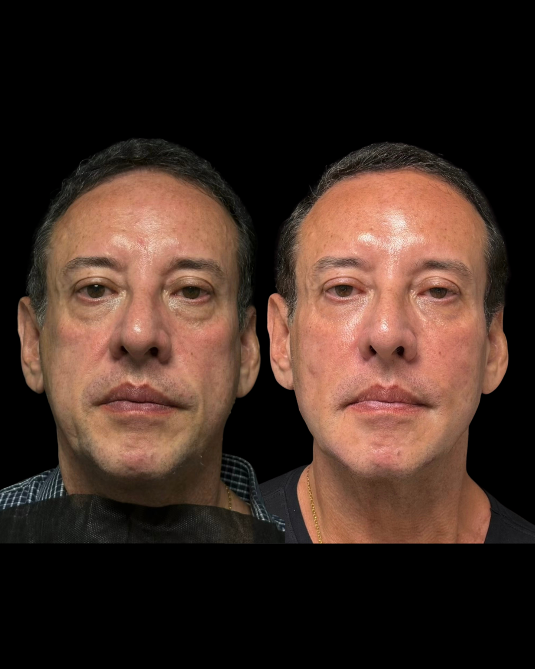 Depoimento de paciente - Preenchimento com Ácido Hialurônico Niterói