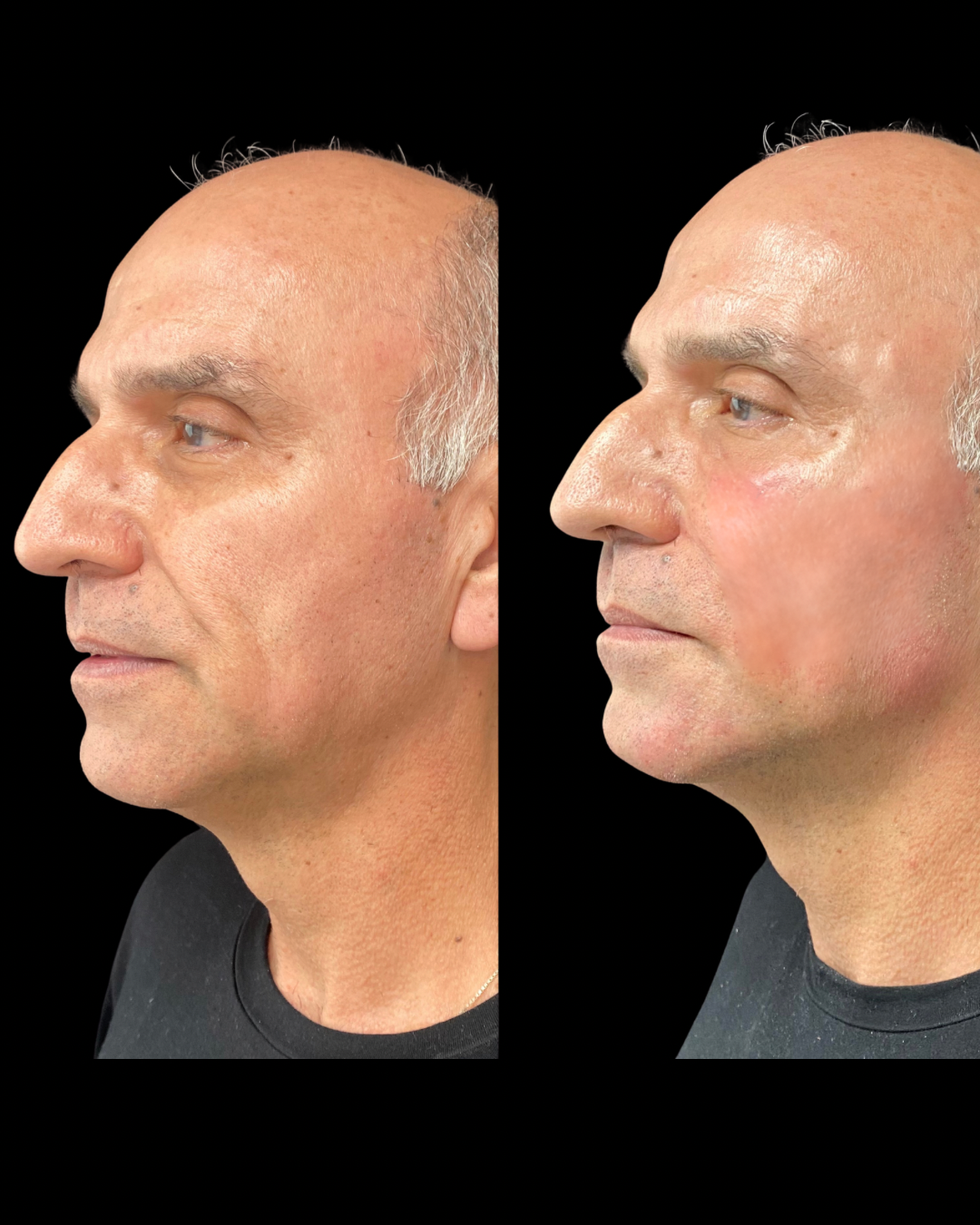 Avaliação de paciente - Harmonização orofacial Niterói RJ